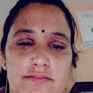 मंडी-हाई स्कूल में फटा कुकर, मिड डे मील वर्कर घायल:चुनावी दल के लिए बना रही थी खाना; मेडिकल कॉलेज नेरचौक किया रेफर