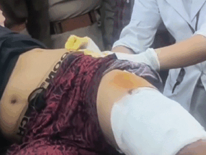 शिमला में युवक पर भालू का हमला:बगीचे में प्लम तोड़ रहा था, पैर समेत शरीर के अन्य हिस्सों में आई चोट; जंगल भागा