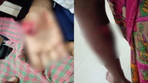 शौचालय जाते छात्र पर टूट पड़ा आवारा कुत्ता, उंगली काटी; हाथ और पैर भी नोंचा​on August 12, 2026 at 3:36 pm