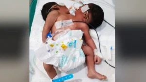 अस्पताल में हुआ दो सिर वाले बच्चे का जन्म, चमत्कार या मेडिकल डिसॉर्डर? डॉक्टरों की निगरानी में नवजात​on October 13, 2026 at 3:18 pm